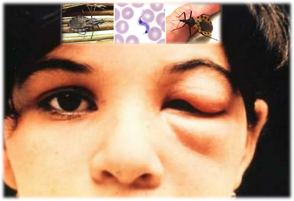 Los peligros y consecuencias si no es curada la enfermedad de Chagas
